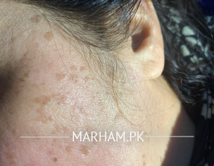 Melasma Treatment 
