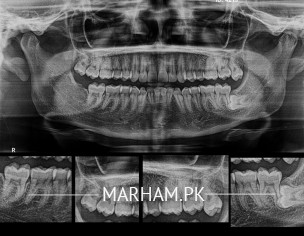 Wisdom Tooth Extraction