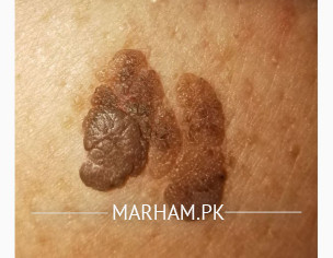 Mole Or What On Back?