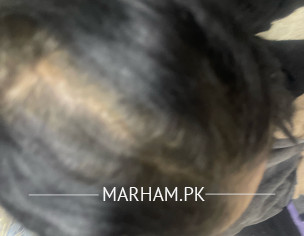 Hair Falling And Dandruff