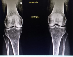 Gap In Knee