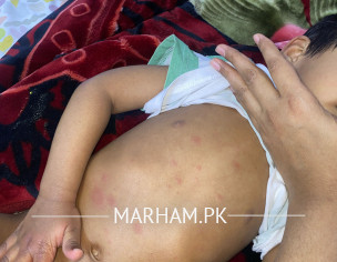 Skin Redness And Rashes 