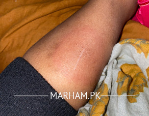 Skin Redness And Rashes 