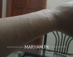 Skin Infection During Pregnancy