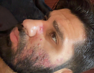 Acne And Stomach Problem