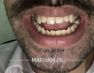 Teeth Skeletal Open Bite