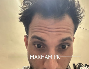 Receding Hair Problem