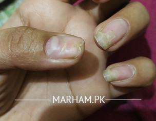 Nails Problem
