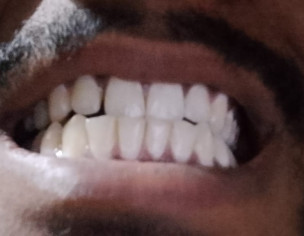 Gap Between Teeth
