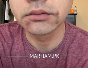 Identifying Skin Problem