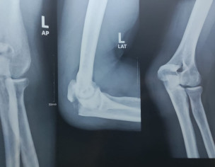 Left Elbow Injury