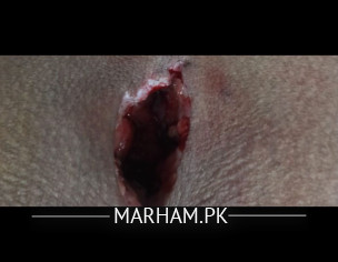 Pilonidal Sinus Healing