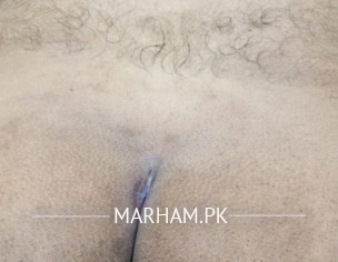 Pilonidal Sinus Healing