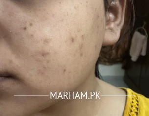 Acne And Dark Spots 