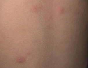 Mosquito Bites