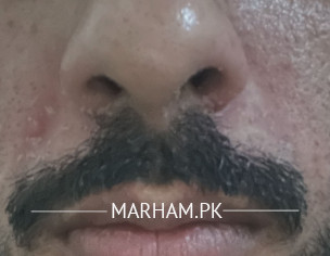 Seborrheic Dermatitis