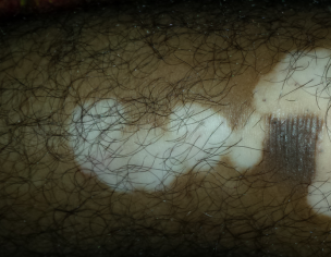 Vitiligo White Patches