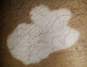 Vitiligo White Patches