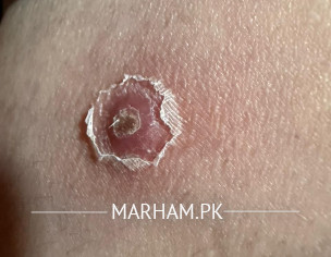 Very Painful Boil Keep Coming Back