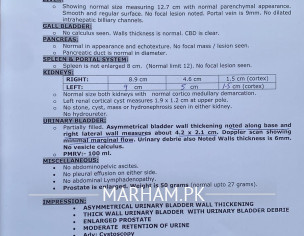 Asymmetrical Urinry Bladder