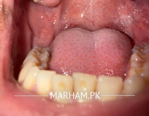 Mouth Ulcer 