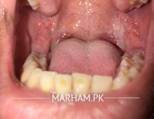 Mouth Ulcer 