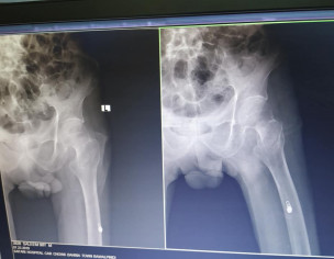 Femur Neck Fracture