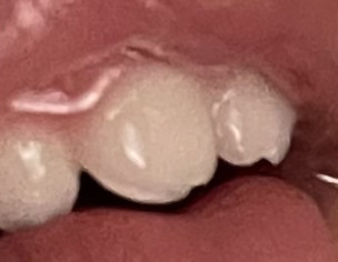 Chipped Teeth In Baby