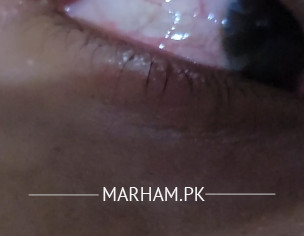 Eye Problem
