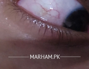 Eye Problem
