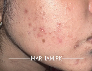 Comedonal Acne 