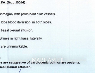 Cardiogenic Pulmonary Oedema
