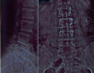 Backbobe Pain