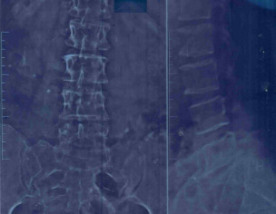 Backbobe Pain