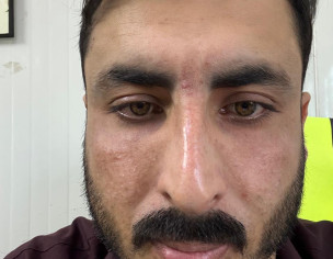 Melasma, Hyperpigmentation, And Facial Dermal Dehydration