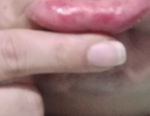 Red Patches On Lips