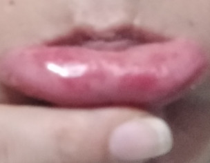 Red Patches On Lips