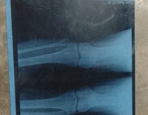 Knee Pain