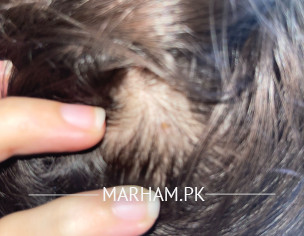 Hair Problem