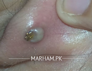 Ear Piercing Infection