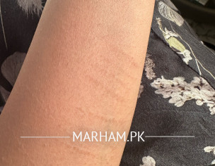 Burn Scars On Arm Area 