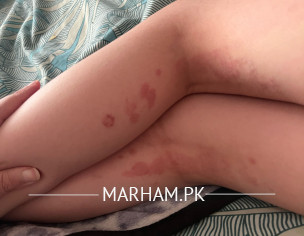 Skin Allergy Under Knees 