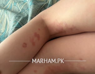 Skin Allergy Under Knees 