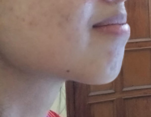 Overbite Issue , Smile Isnt Balanced