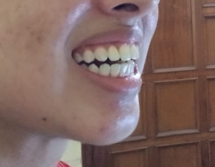 Overbite Issue , Smile Isnt Balanced