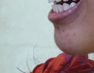 Overbite Issue , Smile Isnt Balanced