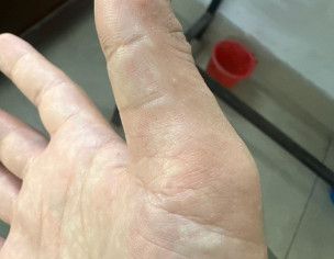 Stubborn Tinea Pedis Vesicular
