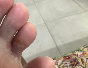 Stubborn Tinea Pedis Vesicular