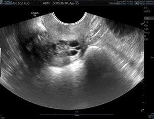 Irregular Periods