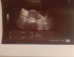 Pregnancy